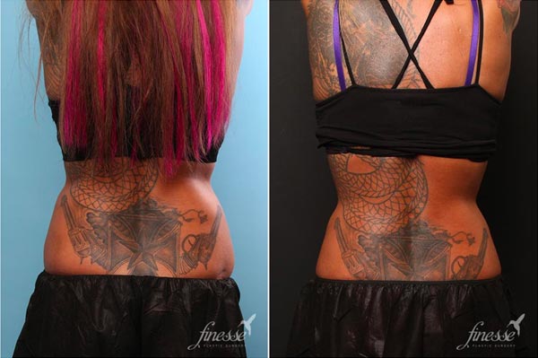 Before and after picture of a patient who underwent a coolsculpting treatment to flanks.