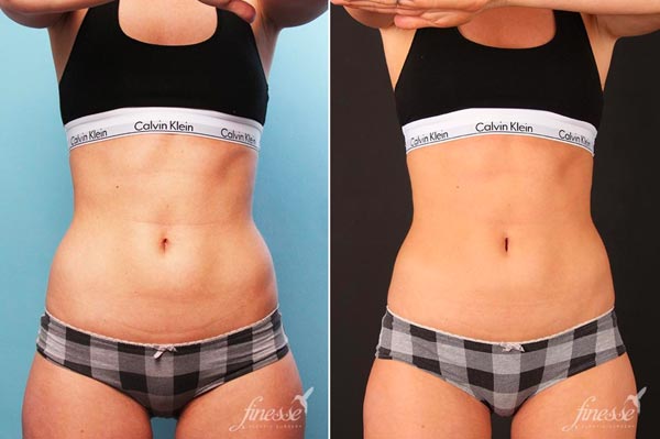 Before and after 8 weeks: Patient who underwent a coolsculpting treatment to flanks