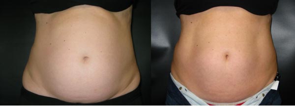 Coolsculpting of the abdomen, before and eight weeks after.