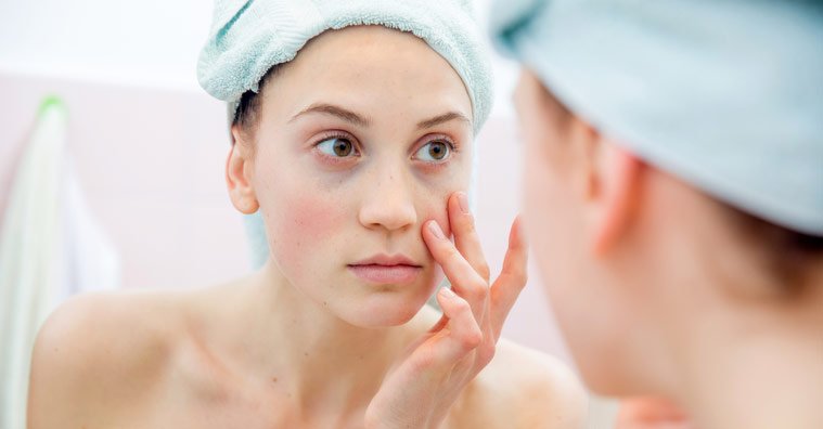 At-Home Treatments for Dark Circles Under Your Eye