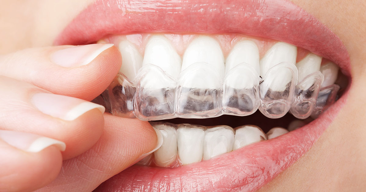 how to choose an at home teeth whitening system that works